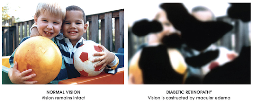 Diabetic Retinopathy vision example