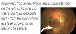 Abnormal, fragile new blood vessels place tension on the retina. As a result, the retina folds and pulls away from the back of the eye (see arrow). Vision loss will be severe.