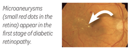 Microaneurysms (small red dots in the retina) appear in the first stage of diabetic retinopathy