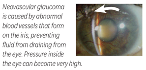 Neovascular glaucoma is caused by abnormal blood vessels that form on the iris, preventing fluid from draining from the eye. Pressure inside the eye can become very high. 