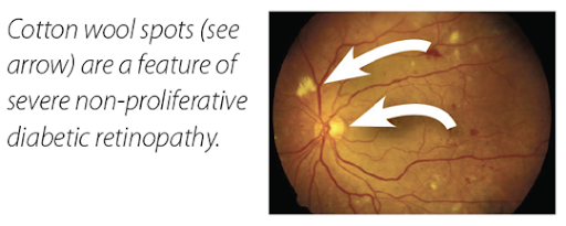 Cotton wool spots (see arrow) are a feature of severe non-proliferative diabetic retinopathy.