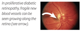 In proliferative diabetic retinopathy, fragile new blood vessels can be seen growing along the retina (see arrow).